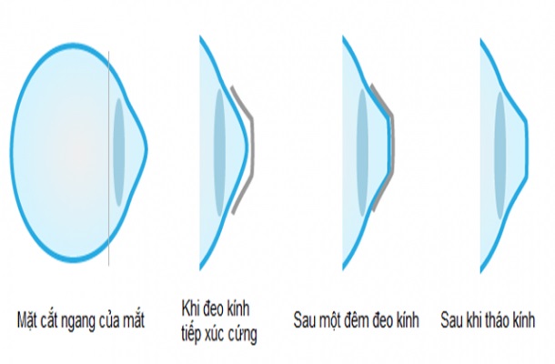 Kính Otho - K giúp điều chỉnh tật khúc xạ bằng cách đeo kính vào ban đêm