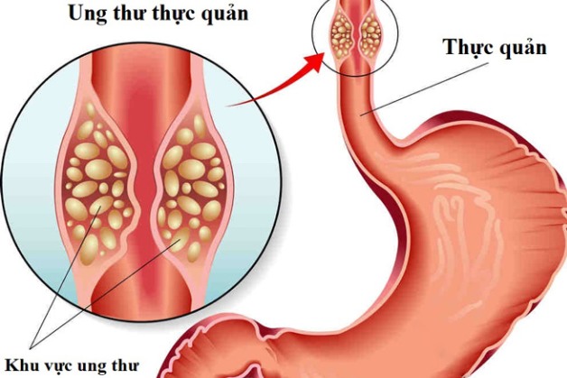 sàng lọc ung thư