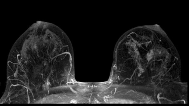 hình ảnh cấu trúc tuyến vú trên phim chụp MRI