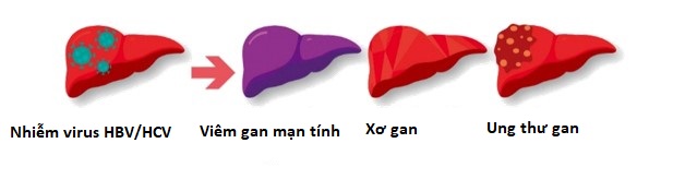 Tại sao ung thư gan ở nam giới xảy ra nhiều hơn ở nữ giới