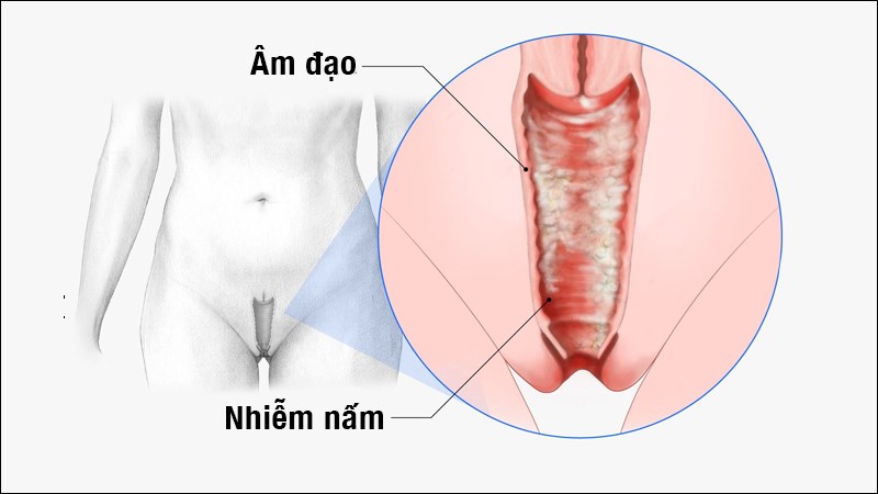 nấm sợi âm đạo