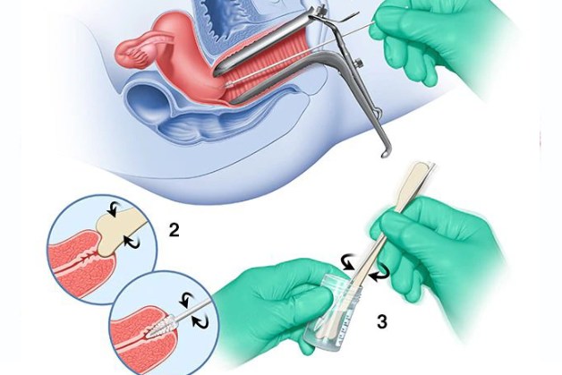 Tầm soát ung thư cổ tử cung papsmear