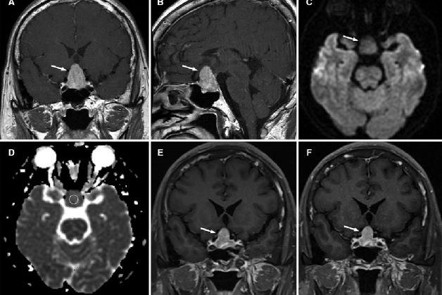 chụp mri tuyến yên