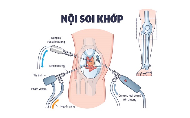 nội soi khớp gối