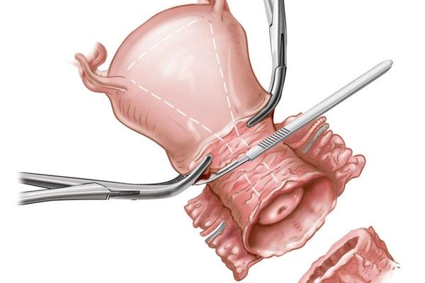 phẫu thuật ung thư cổ tử cung là bệnh lý như thế nào