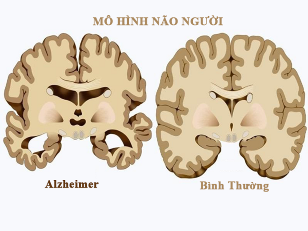 chẩn đoán hình ảnh alzheimer