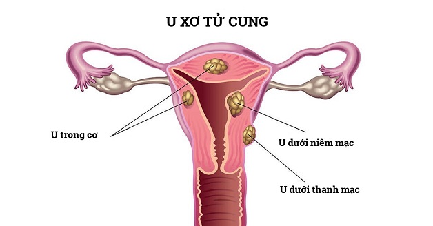 U xơ có thể nằm ở nhiều vị trí, với kích thước lớn nhỏ khác nhau