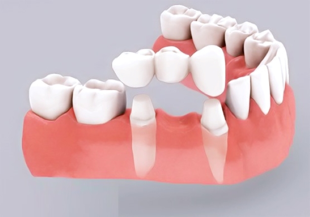 Phương pháp trồng răng giả