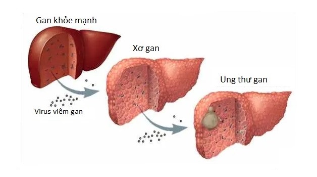 Giải đáp xơ gan có phải bệnh ung thư gan không?
