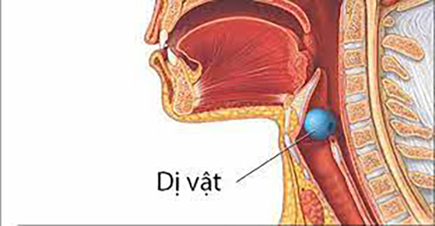 quy trinh lấy dị vật họng miệng 2
