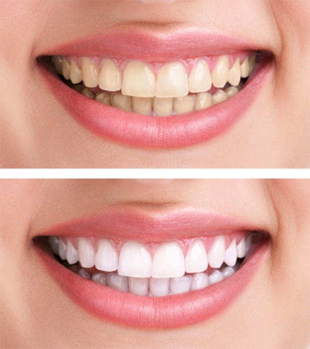 Tình trạng răng nhiễm Tetracycline