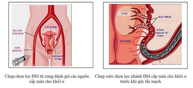 Phương pháp điều trị hiện đại - nút mạch u xơ tử cung