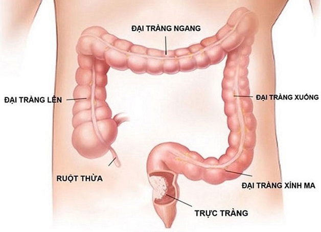 nguyên nhân tại sao lại viêm đại tràng
