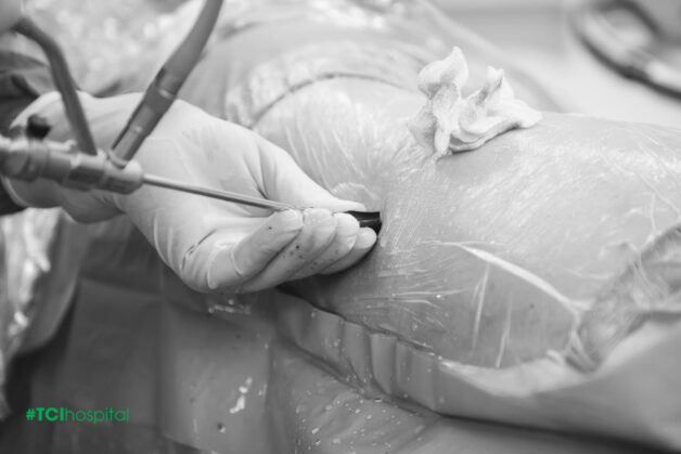 Lấy sạch 4 viên sỏi thận kích thước lớn trong 1 lần tán sỏi qua da