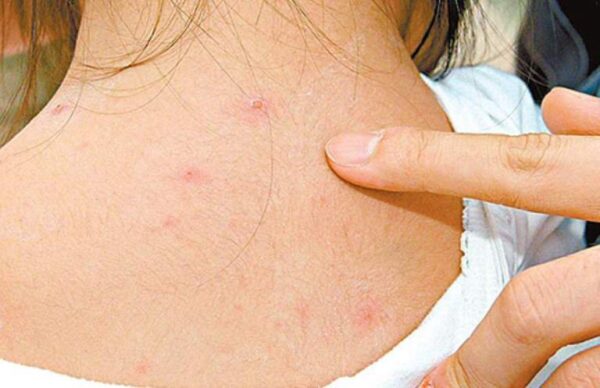 thời gian ủ bệnh thủy đậu