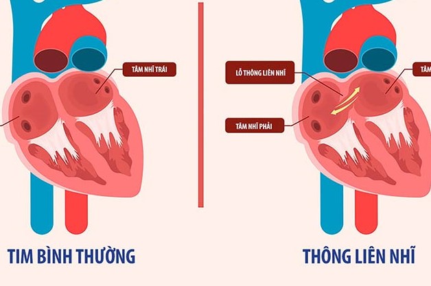 6-10% bệnh nhân thông liên nhĩ là do bẩm sinh