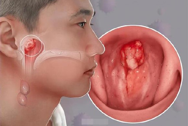 khi nào nên sàng lọc ung thư vòm họng