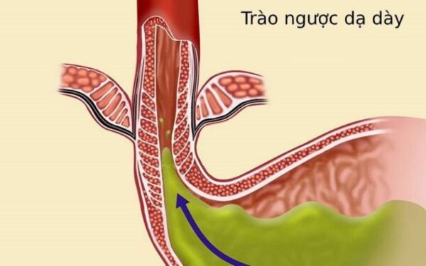 Nguyên nhân trào ngược dạ dày thực quản