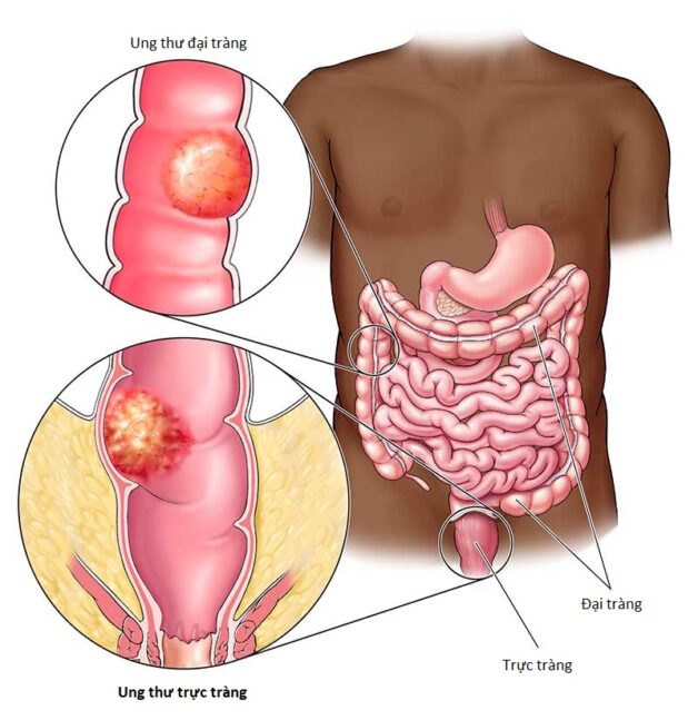 Tất cả thông tin về ung thư trực tràng giai đoạn di căn