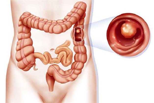 Ung thư polyp đại tràng là bệnh lý nguy hiểm ở hệ tiêu hóa