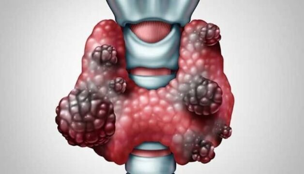 Hiểu biết về bệnh ung thư tuyến giáp giai đoạn di căn