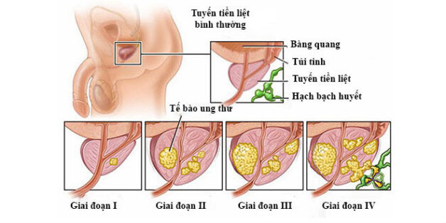 Lý giải ung thư tuyến tiền liệt có thể sống được bao lâu