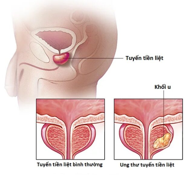 Lý giải ung thư tuyến tiền liệt có thể sống được bao lâu