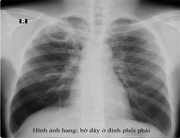 hình ảnh lao phổi trên phim X-quang