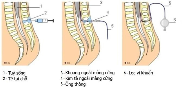 Chất gây tê được tiêm vào không gian khoang màng cứng, nằm giữa màng cứng và màng mềm của cột sống