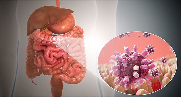 Viêm dạ dày ruột cấp là bệnh phổ biến ở hệ tiêu hóa