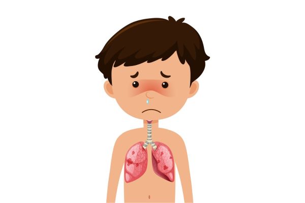 Viêm phổi là một bệnh lý đường hô hấp thường gặp ở trẻ nhỏ