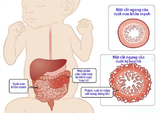Thận trọng với viêm ruột hoại tử ở trẻ sơ sinh