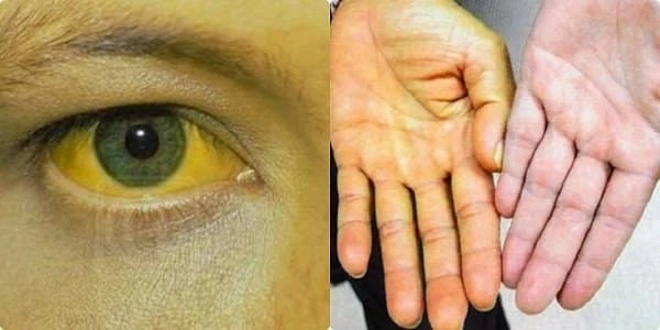 Ung thư phổi di căn có biểu hiện thế nào?