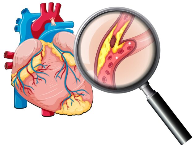 Những cục máu đông là nguyên nhân thiếu máu cơ tim