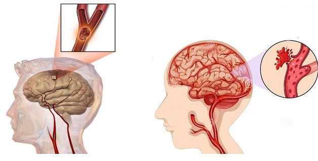 Hai dạng tai biến mạch máu não thường gặp