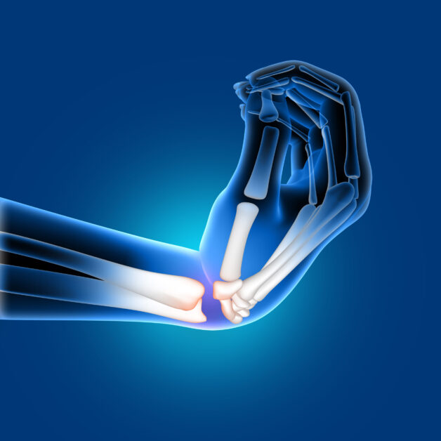 Chèn ép dây thần kinh giữa khi đi qua ống cổ tay.