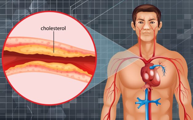 Thiếu máu cục bộ cơ tim là gì