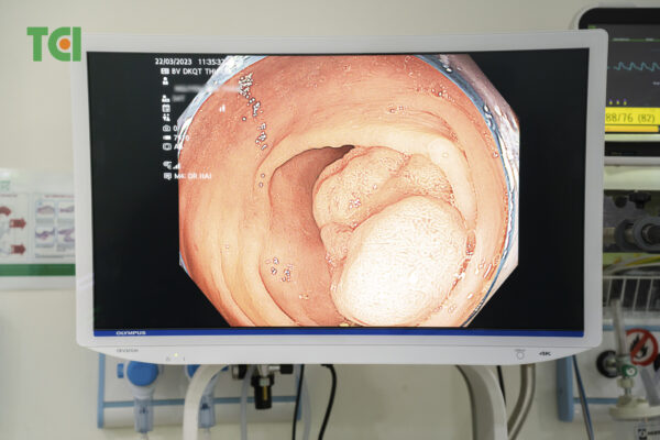 Hình ảnh polyp đại tràng lớn qua nội soi