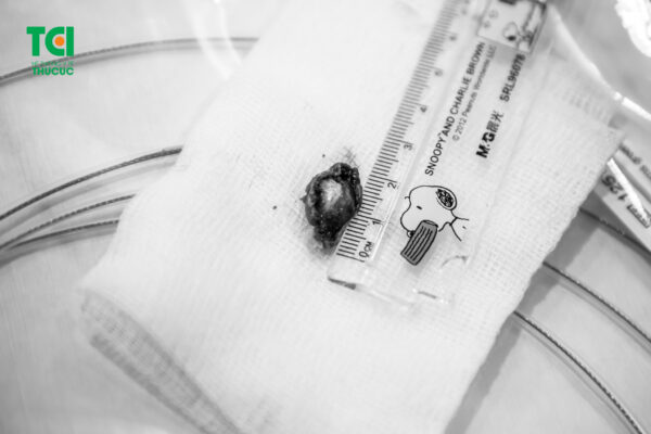 Polyp sau khi được cắt qua nội soi