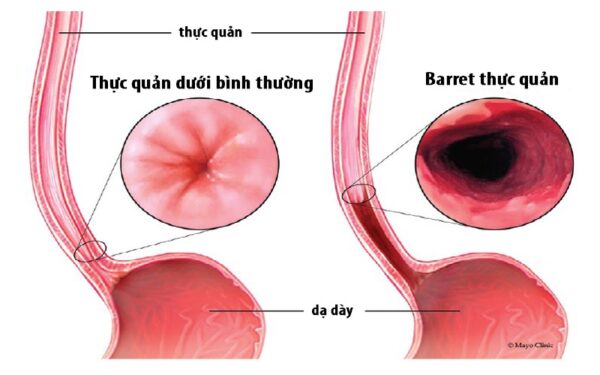 Biến chứng trào ngược dạ dày lâu năm