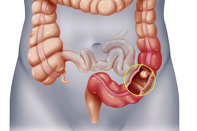 Bệnh Crohn có thể gây ra biến chứng ung thư đại tràng