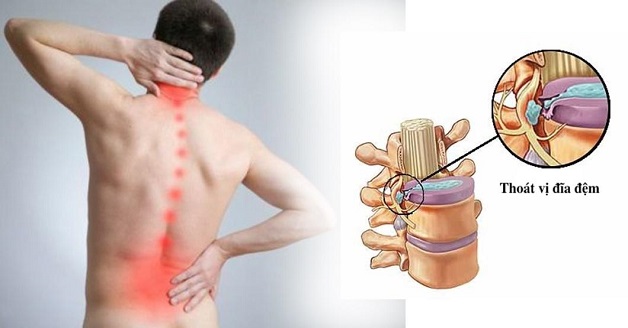 Bệnh lý thoát vị đĩa đệm ngày càng có xu hướng trẻ hóa.