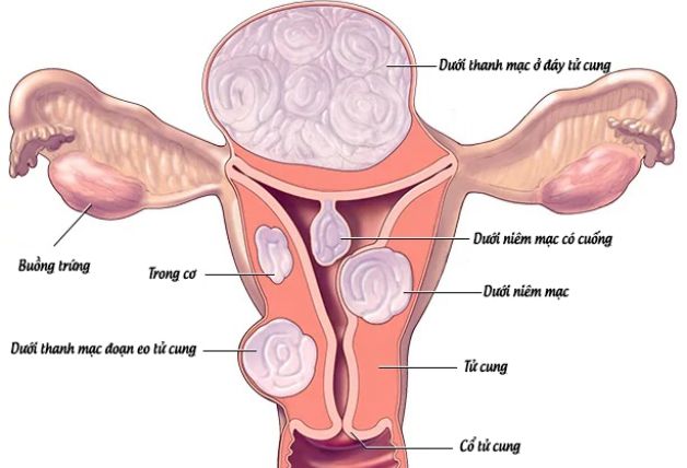bệnh nhân xơ cổ tử cung