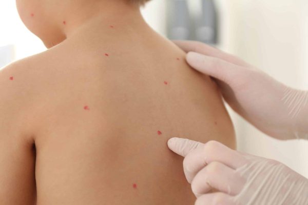 Trẻ mắc thủy đậu thường có những mụn nước đỏ li ti, nằm rải rác trên bề mặt da