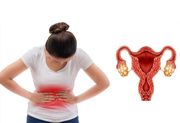 Hội chứng buồng trứng đa nang là một trong các nguyên nhân chính
