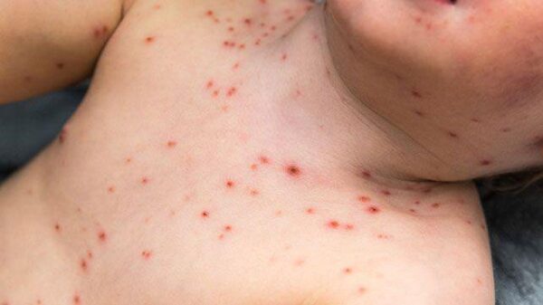 biến chứng bệnh thủy đậu