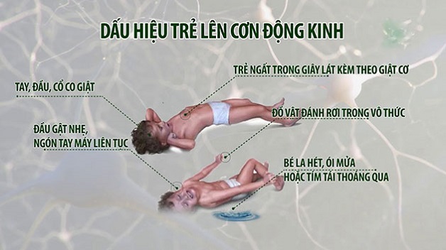 biểu hiện động kinh khi ngủ