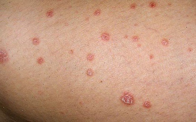 Bệnh lậu gây đau và khó chịu khi quan hệ
