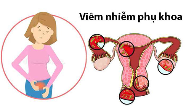 Các bệnh về viêm phụ khoa phổ biến, bao gồm viêm âm đạo, viêm cổ tử cung, viêm tử cung,..