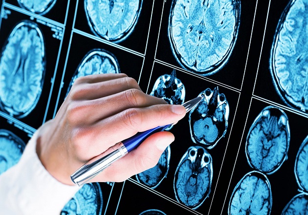 muốn tìm cách chữa bệnh động kinh cần tìm đúng nguyên nhân
